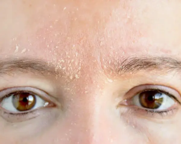Trockene Gesichtshaut bei Männern: Ursachen, Symptome und Pflege Tipps