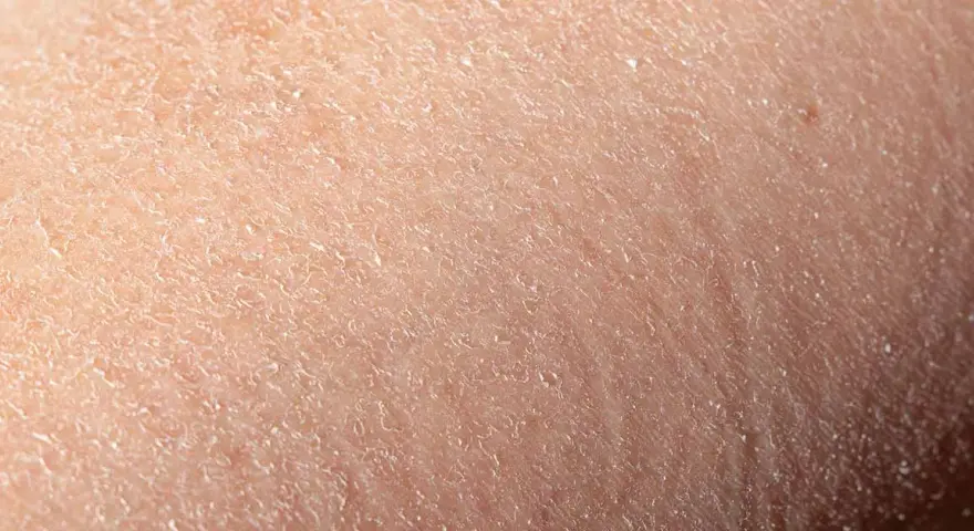 Ursachen und Lösungen für trockene schuppige Gesichtshaut verstehen