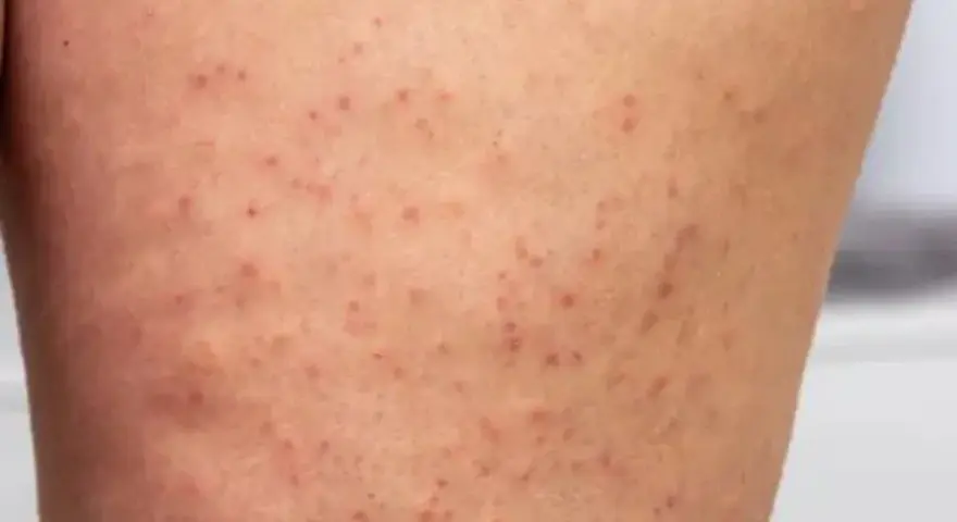 Eingewachsenes Haar am Bein: Ursachen, Behandlung und Vorbeugung