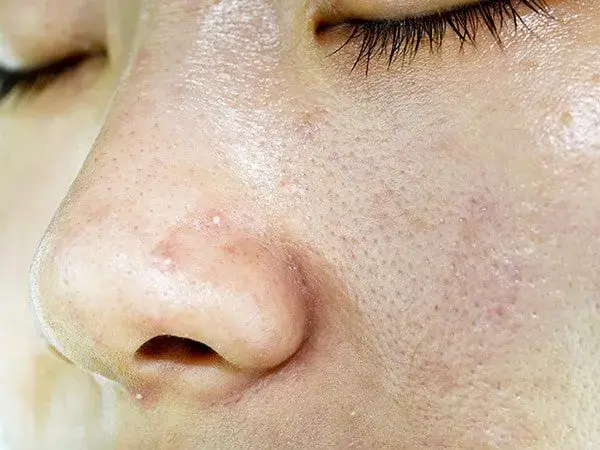 Fettige Gesichtshaut: Ursachen, Pflege und Tipps für klare Haut
