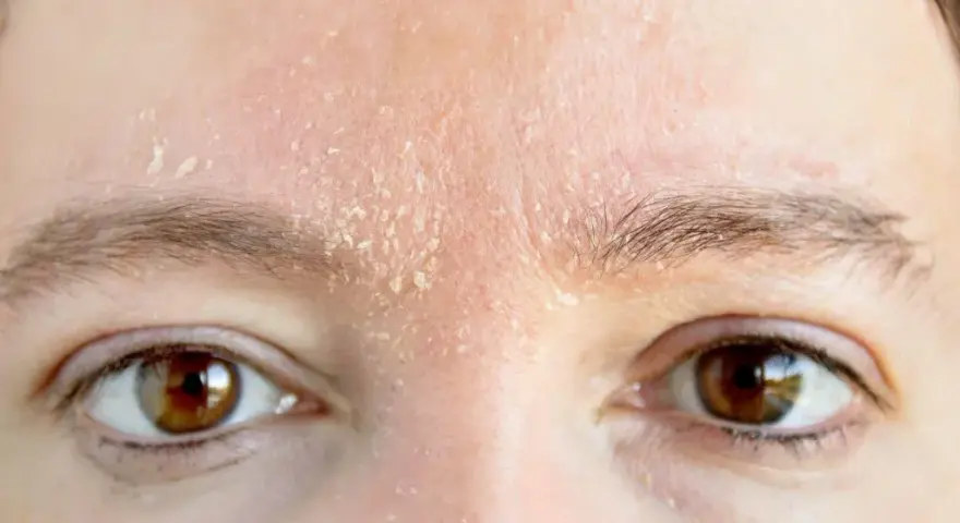 Trockene Gesichtshaut bei Männern: Ursachen, Symptome und Pflege Tipps