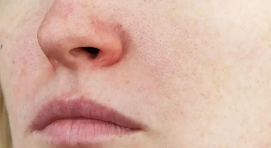 Rote Gesichtshaut Ursachen: Verborgene Gründe und wirksame Lösungen